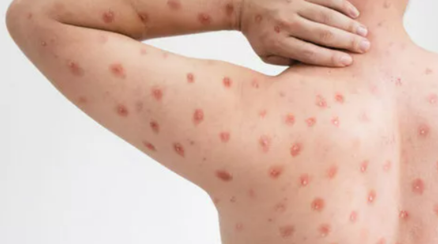 Yeni salgın korkutuyor! Domates gribi belirtileri nedir? Nasıl bulaşır?