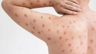 Yeni salgın korkutuyor! Domates gribi belirtileri nedir? Nasıl bulaşır?