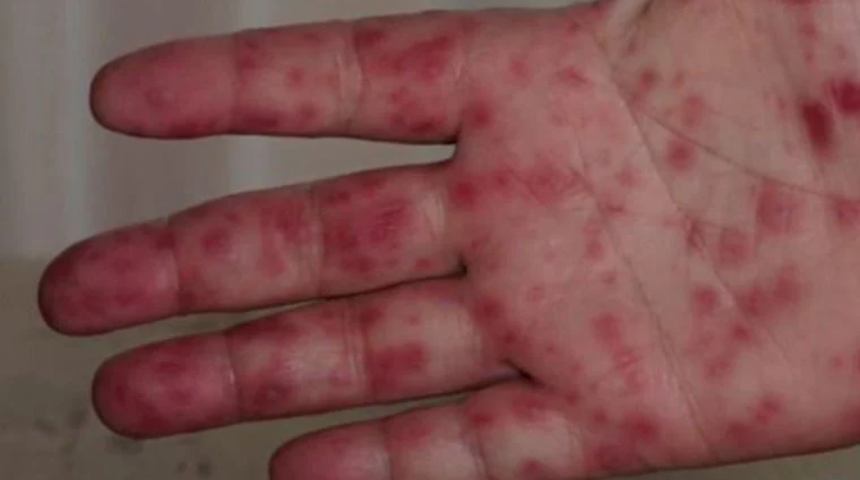 Domates gribi öldürür mü? Domates gribi nedir, tedavisi var mı?