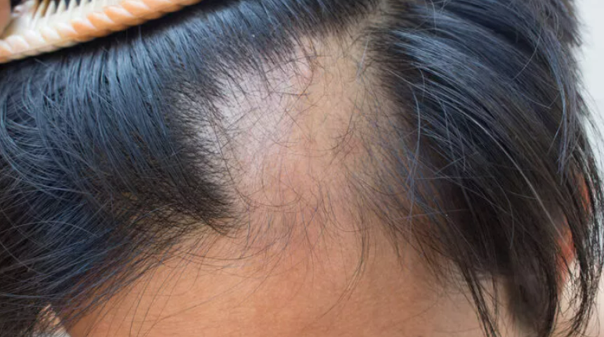 Üzülmeyin çözümü basit! Saç kıranı geçirmek için…