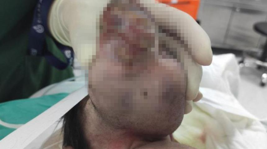 Kahramanmaraş'ta bu bebeği gören şaşırıyor! Beyninin yarısı kafatası dışında doğdu