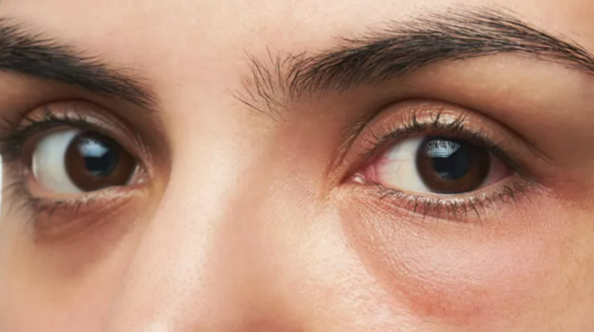 Göz altı torbalarınızdan şikayet etmeyi bırakın! Göz altı torbalarınızdan doğal yöntemler ile çözün