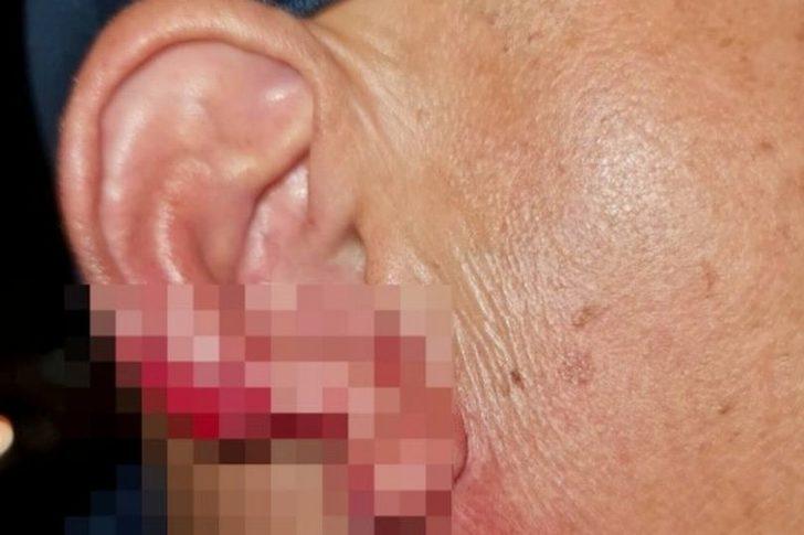 Sarhoş seks işçisi öpme bahanesiyle yaklaştığı turistin kulağını kopartıp yedi! Görenler şaşkınlığını gizleyemedi G1