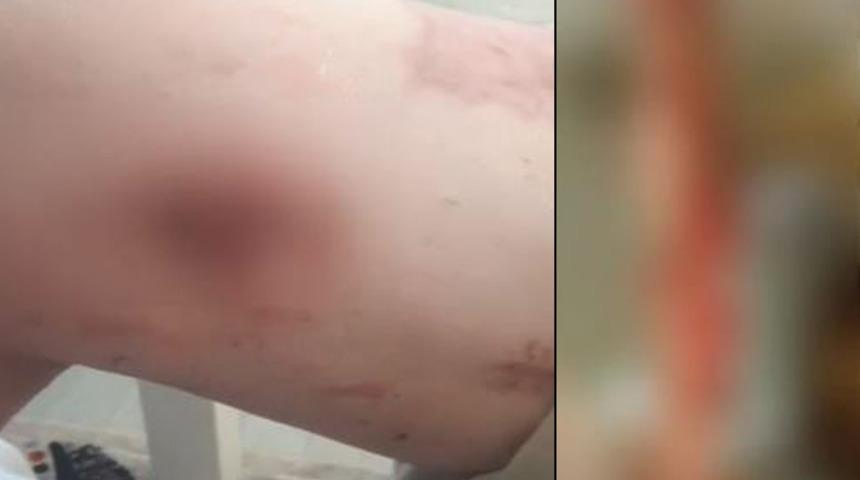 Ameliyat sırasında bacağında 1,5 metrelik sargı bezi unuttular! Cımbızla çekmeye başladı, gördüklerine inanamadı