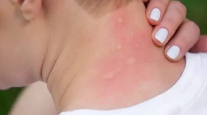 Yazın en büyük derdi! Sivrisineklerin neden olduğu tüm kaşıntıyı alacak