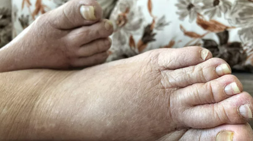 Önceden önleminizi alın: Bu kişiler risk altında! Lenfödem hastalığında dikkat edilmesi gerekenler