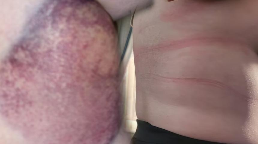 En büyük felaketi düğün günü yaşadı: Sütyen takamıyor, duş bile alamıyor! “Her yerimde varmış gibi”