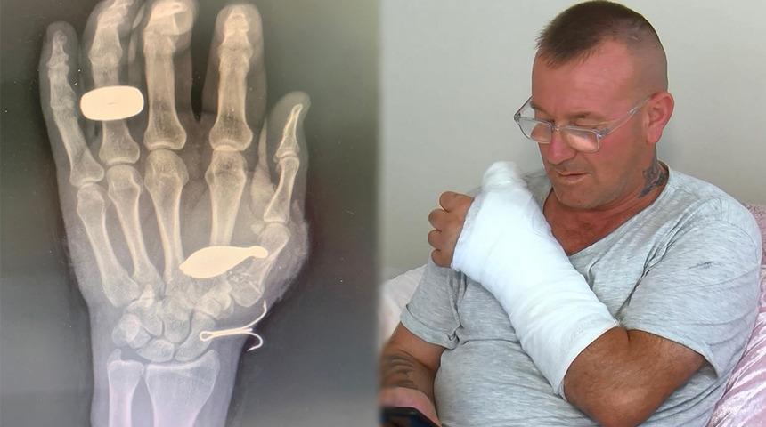 Oltasını kurtarmaya çalışırken el kemiğine balık kurşunu saplanan adam: "Kimse inanmıyor... Bu saatten sonra balık tutmam"