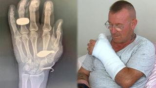 Oltasını kurtarmaya çalışırken el kemiğine balık kurşunu saplanan adam: Kimse inanmıyor... Bu saatten sonra balık tutmam