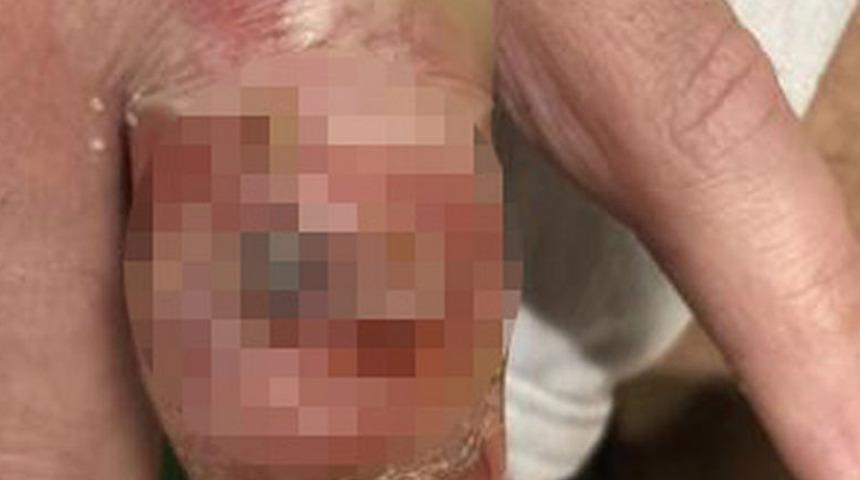 Balon gibi şişti! Küçük bir ısırık canından ediyordu: Yüzde 90’ını kaybetti