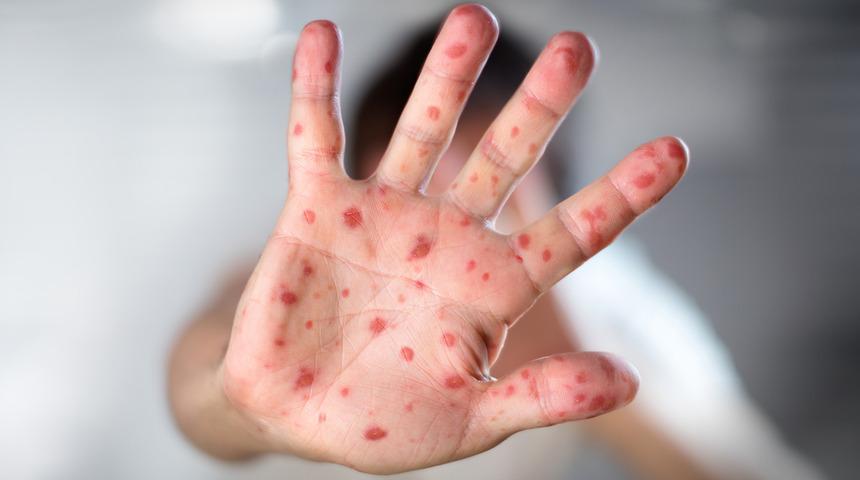 Domates gribi nedir, domates gribi belirtileri nelerdir?