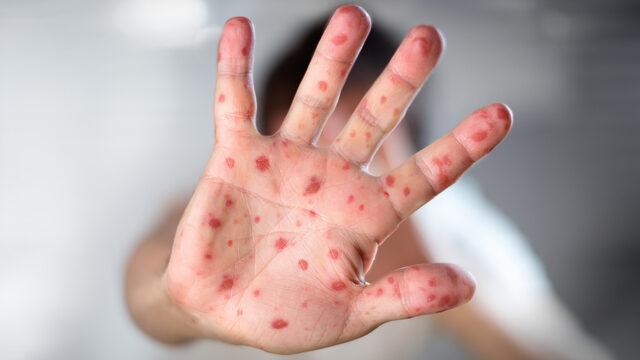 Domates gribi nedir, domates gribi belirtileri nelerdir?