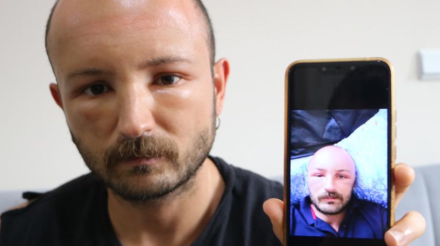 Tatil için gittiği Zonguldak'ta denize girdi! Başı şişmeye başladı...