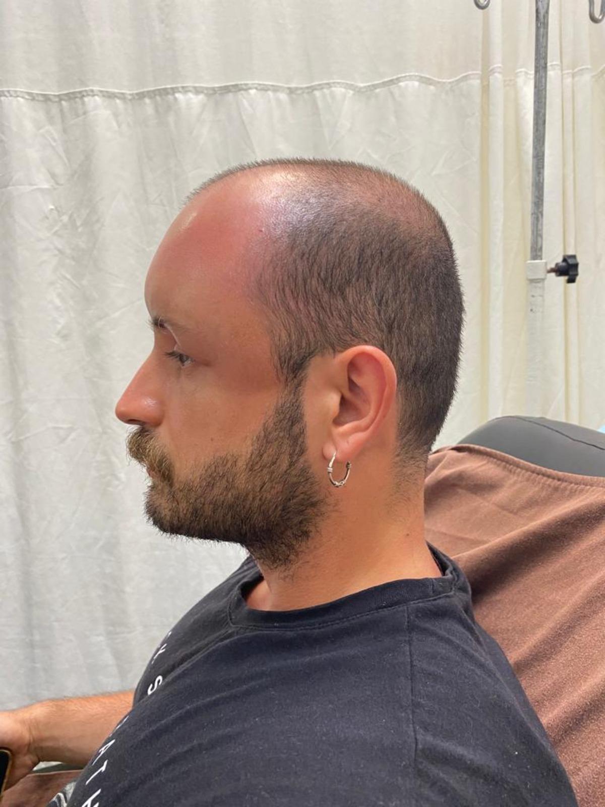 Zonguldak'ta sıcaktan etkilenen hastanın kafa derisinde "sıcak &ouml;demi" oluştu