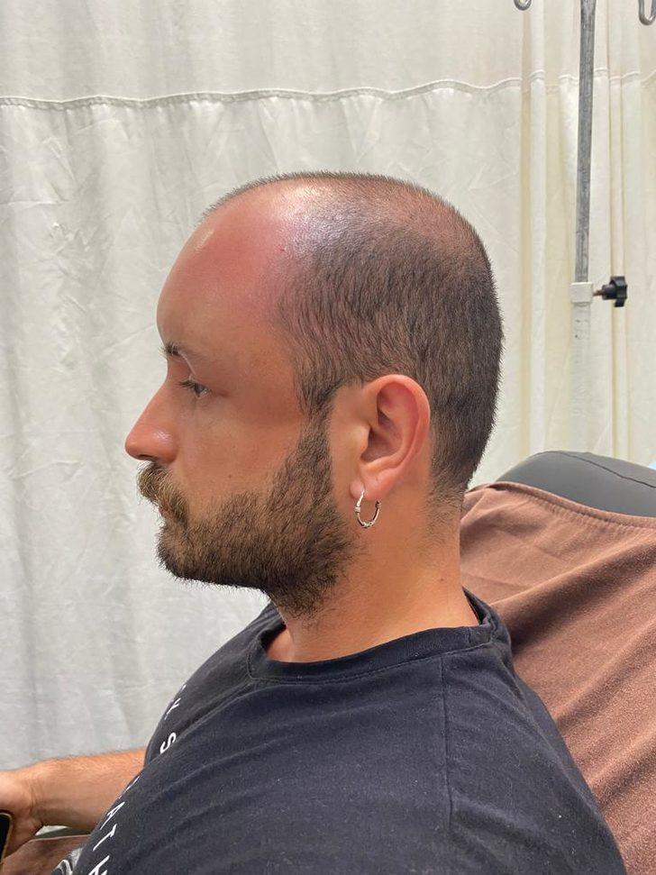 Zonguldak'ta sıcaktan etkilenen hastanın kafa derisinde "sıcak ödemi" oluştu G1