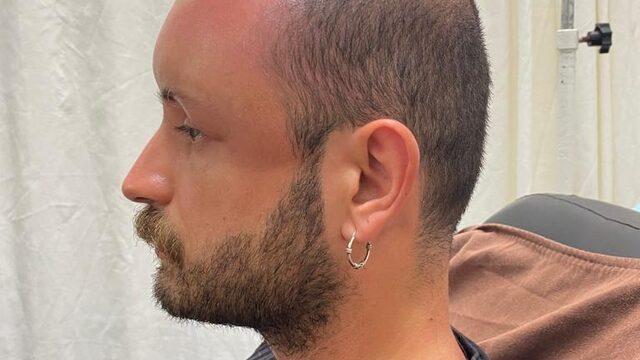 Zonguldak'ta sıcaktan etkilenen hastanın kafa derisinde sıcak ödemi oluştu