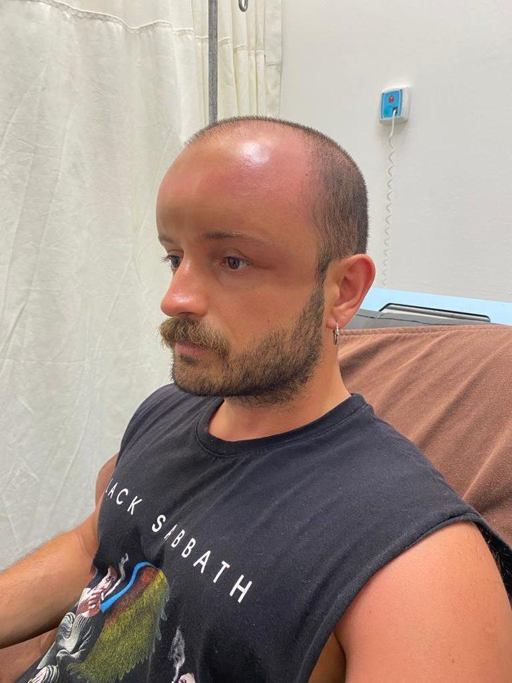 Zonguldak'ta sıcaktan etkilenen hastanın kafa derisinde "sıcak ödemi" oluştu G2