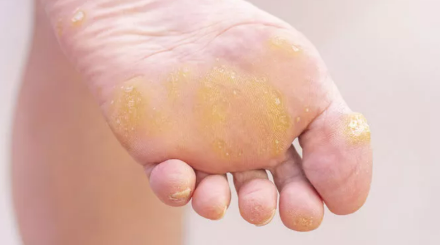 Acıya ve kötü görünüme son! Ayağınızdaki nasırları geçirmek için…