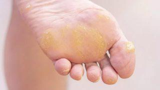 Acıya ve kötü görünüme son! Ayağınızdaki nasırları geçirmek için…