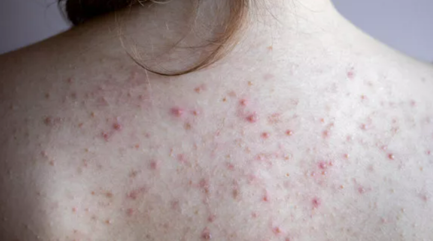 Dert etmeyin: Vücuttaki sivilceleri geçirmek çok kolay! Sırttaki sivilceler nasıl geçer?