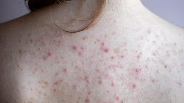 Dert etmeyin: Vücuttaki sivilceleri geçirmek çok kolay! Sırttaki sivilceler nasıl geçer?