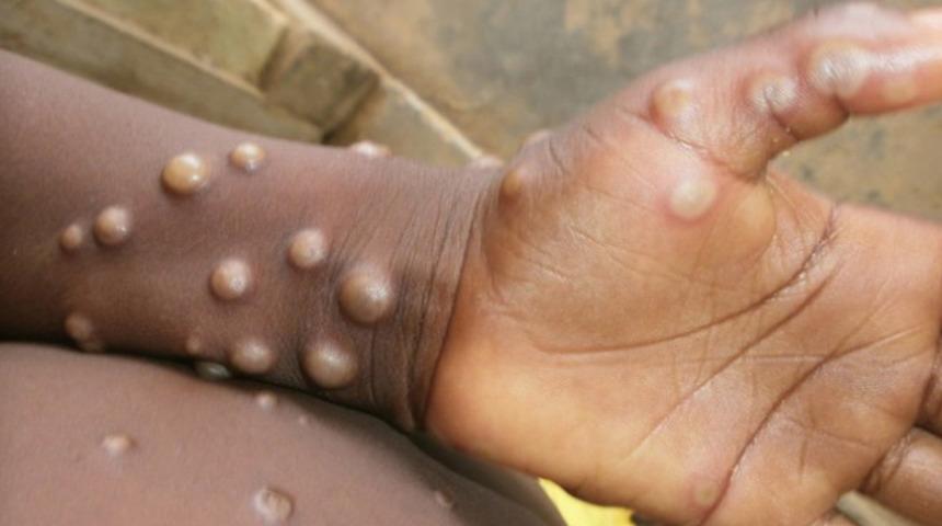 O ülkede korkulan oldu: Maymun çiçeği bağlantılı ilk ölüm gerçekleşti! Hayatını kaybeden kişi...