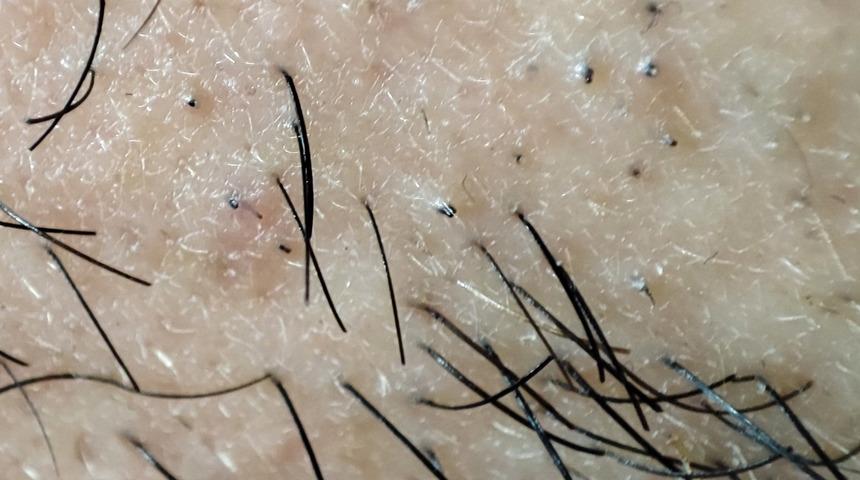 Nokta kadar ama acısı dayanılmaz! Oturarak çalışıyorsanız risk altındasınız