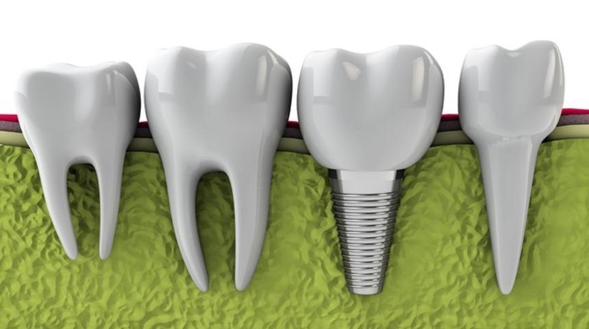 Hastalar sahte diş implantlarına karşı ne yapmalı? 