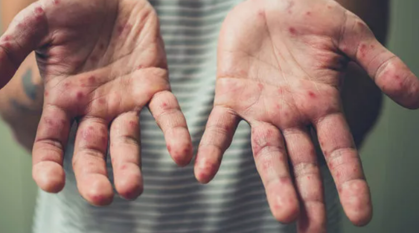 Çok benziyor: Diğer hastalıklarla karıştırmayın! Maymun çiçeği belirtileri