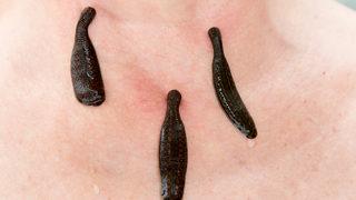 Sülük tedavisindeki hayati risk! Türkiye’deki en büyük problemlerden biri