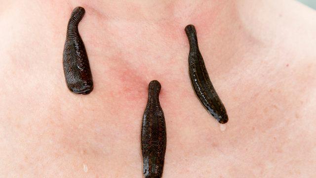 Sülük tedavisindeki hayati risk! Türkiye’deki en büyük problemlerden biri