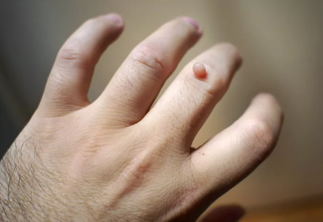 Siğil nasıl ge&ccedil;er diye d&uuml;ş&uuml;nmeyin! Siğilleri ge&ccedil;irmenin &ccedil;&ouml;z&uuml;m&uuml; basit