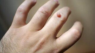 Siğil nasıl geçer diye düşünmeyin! Siğilleri geçirmenin çözümü basit