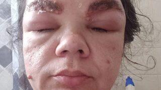 Güzelleşmek için yaptı ama sonuçları çok ağır oldu! Kaşını boyatacakları uyardı