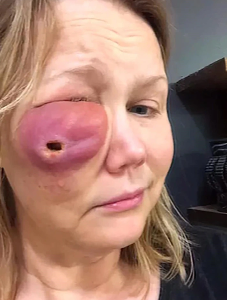 Son haline inanamayacaksınız! Güzelleşmek için dolgu yaptırmak istedi, yüzü delindi G1