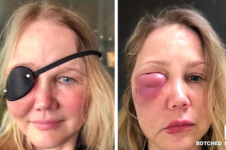 Son haline inanamayacaksınız! Güzelleşmek için dolgu yaptırmak istedi, yüzü delindi G2