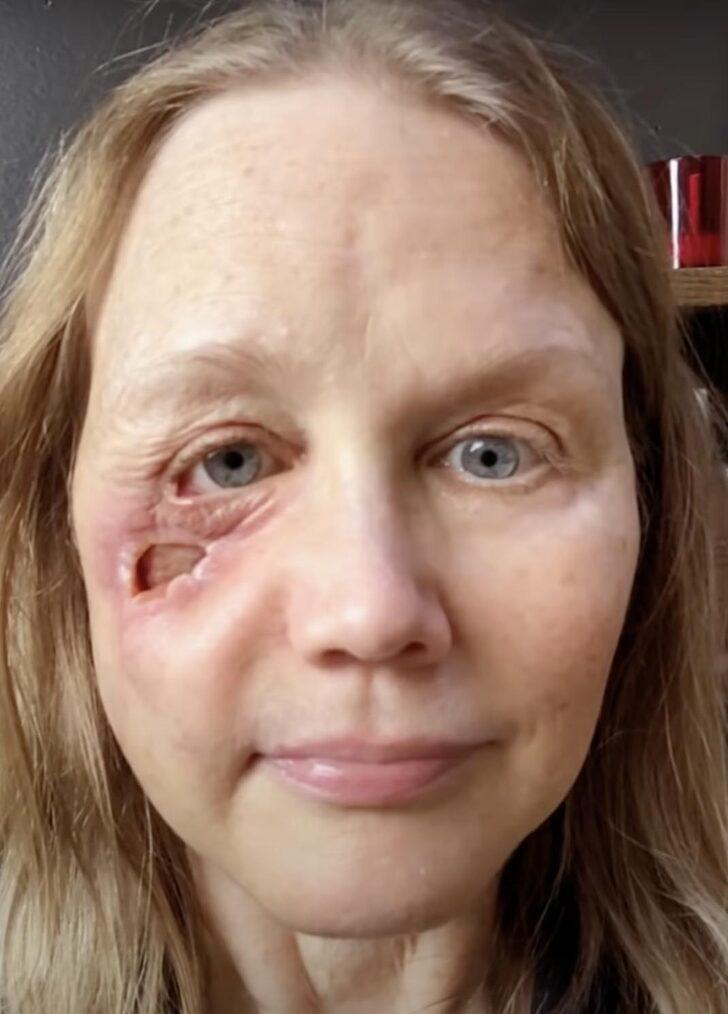 Son haline inanamayacaksınız! Güzelleşmek için dolgu yaptırmak istedi, yüzü delindi G5