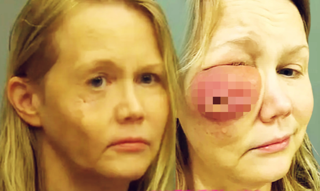 Son haline inanamayacaksınız! G&uuml;zelleşmek i&ccedil;in dolgu yaptırmak istedi, y&uuml;z&uuml; delindi