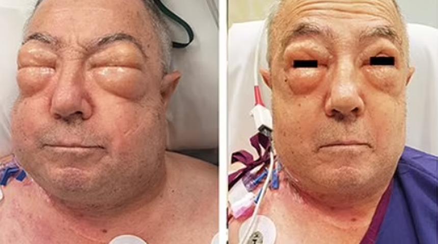 İyileşmek için ameliyat oldu ama şiştikçe şişti!