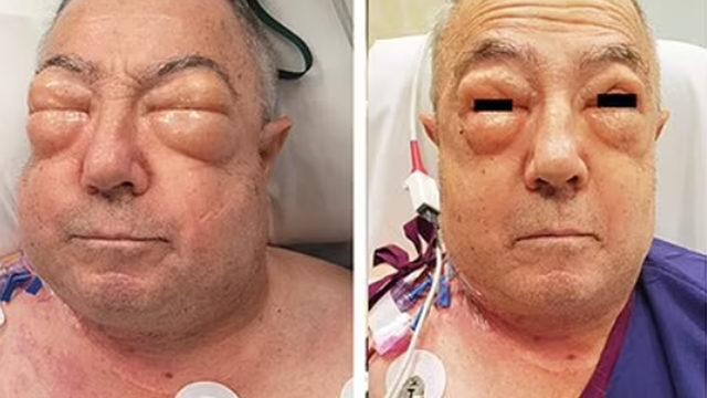 İyileşmek için ameliyat oldu ama şiştikçe şişti!