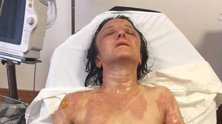 Kaynana gelinini kızgın yağla yaktı