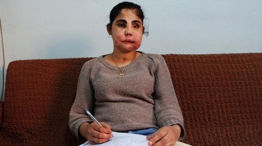 T&uuml;rkiye'nin İlk Y&uuml;zl&uuml; Nakli Olan Hatice Nergiz Hayatını Kaybetti!