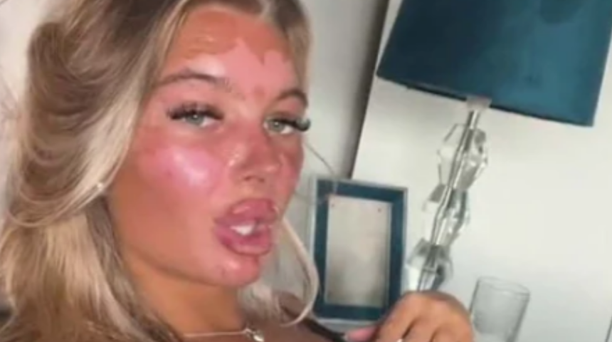 Böylesi görülmedi! Sadece bronzlaşmak istemişti ama…