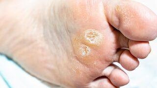 Nasırlara en kısa sürede elveda! Tek malzemeyle direkt çözüm