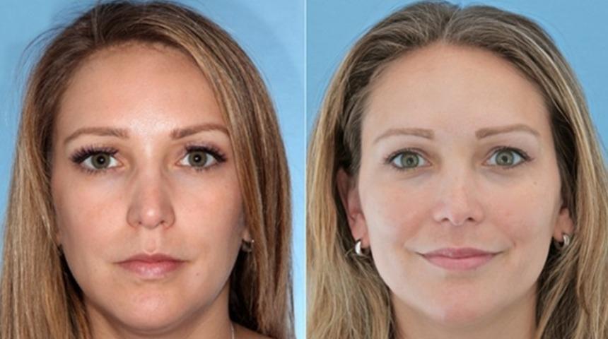 Cilt kırışıklıklarında botoks tedavisi