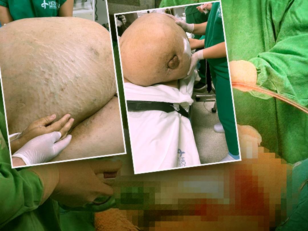 Hareket edemiyor hatta oturamıyordu! 45 yaşındaki kadının i&ccedil;inde 100 kiloluk t&uuml;m&ouml;r &ccedil;ıktı