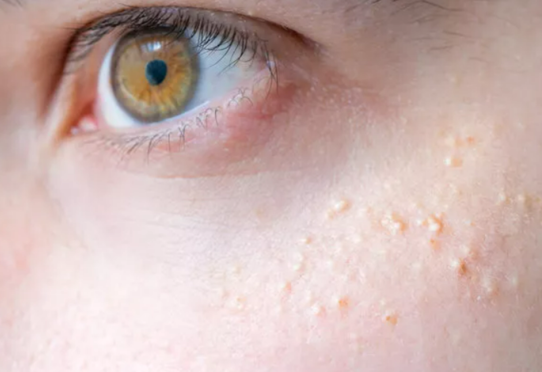 Bir t&uuml;rl&uuml; kurtulamıyorum diyorsanız bu y&ouml;ntemleri deneyin: Yağ bezelerini ge&ccedil;irmek i&ccedil;in doğal &ccedil;&ouml;z&uuml;m