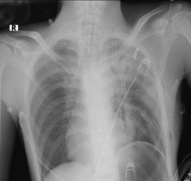 Endonezyalı turist tatil için geldiği Alanya'da göğsündeki 3 kiloluk kitleden kurtuldu G3