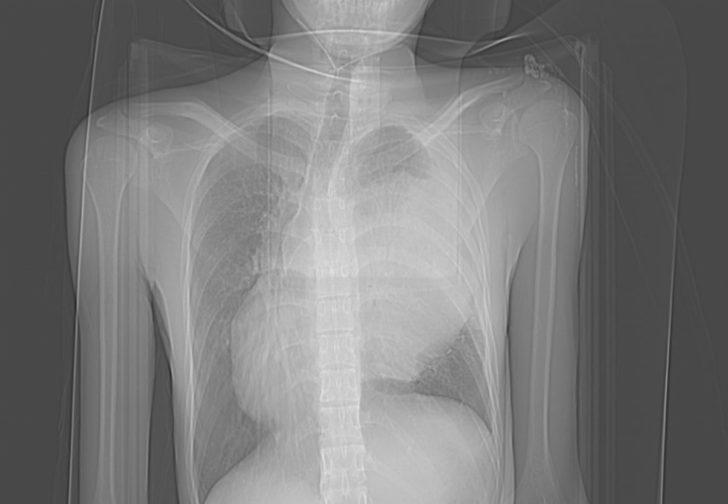 Endonezyalı turist tatil için geldiği Alanya'da göğsündeki 3 kiloluk kitleden kurtuldu G4