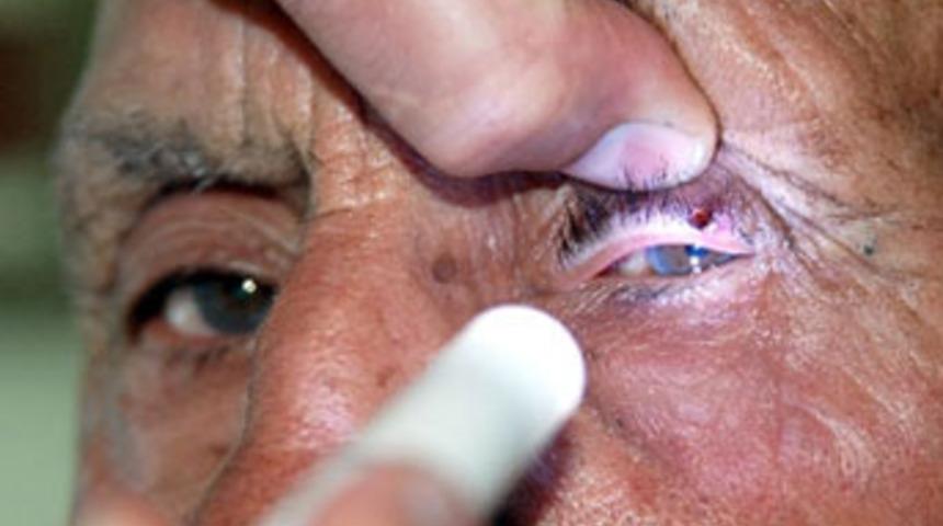 Gözünden kene çıkarıldı